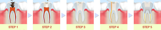 STEP 1 歯の神経を除去し、根管の長さを測ります。<br>
STEP 2 根管内を洗浄します。<br>
STEP 3 根管内を消毒します。<br>
STEP 4 根管充填剤などの薬剤を詰めます。<br>
STEP 5 蓋をします。<br>